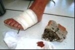PORTO VELHO: Idosa de 74 anos nega dinheiro para neto usuário de drogas e é agredida com pedrada