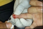 Tratamento da malária P.vivax ainda desafia pesquisadores em Rondônia